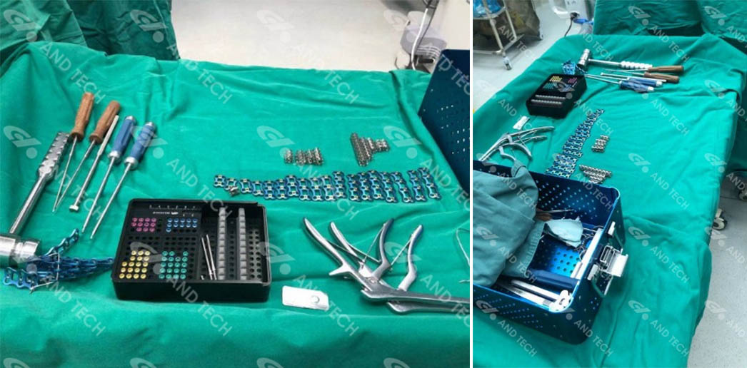 Case Study-Anterior cervical surgery successfully performed1