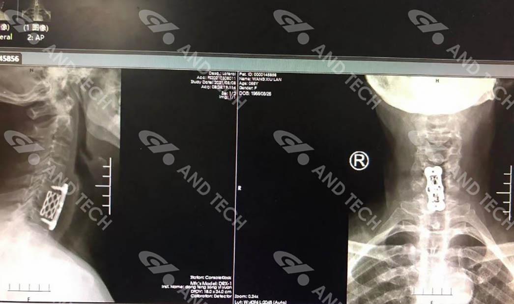 Case Study-Anterior cervical surgery successfully performed2